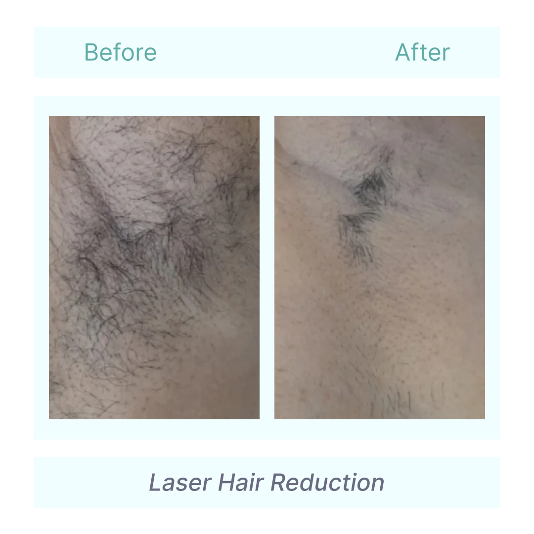 Laser hair removal before and after at Tender Skin International