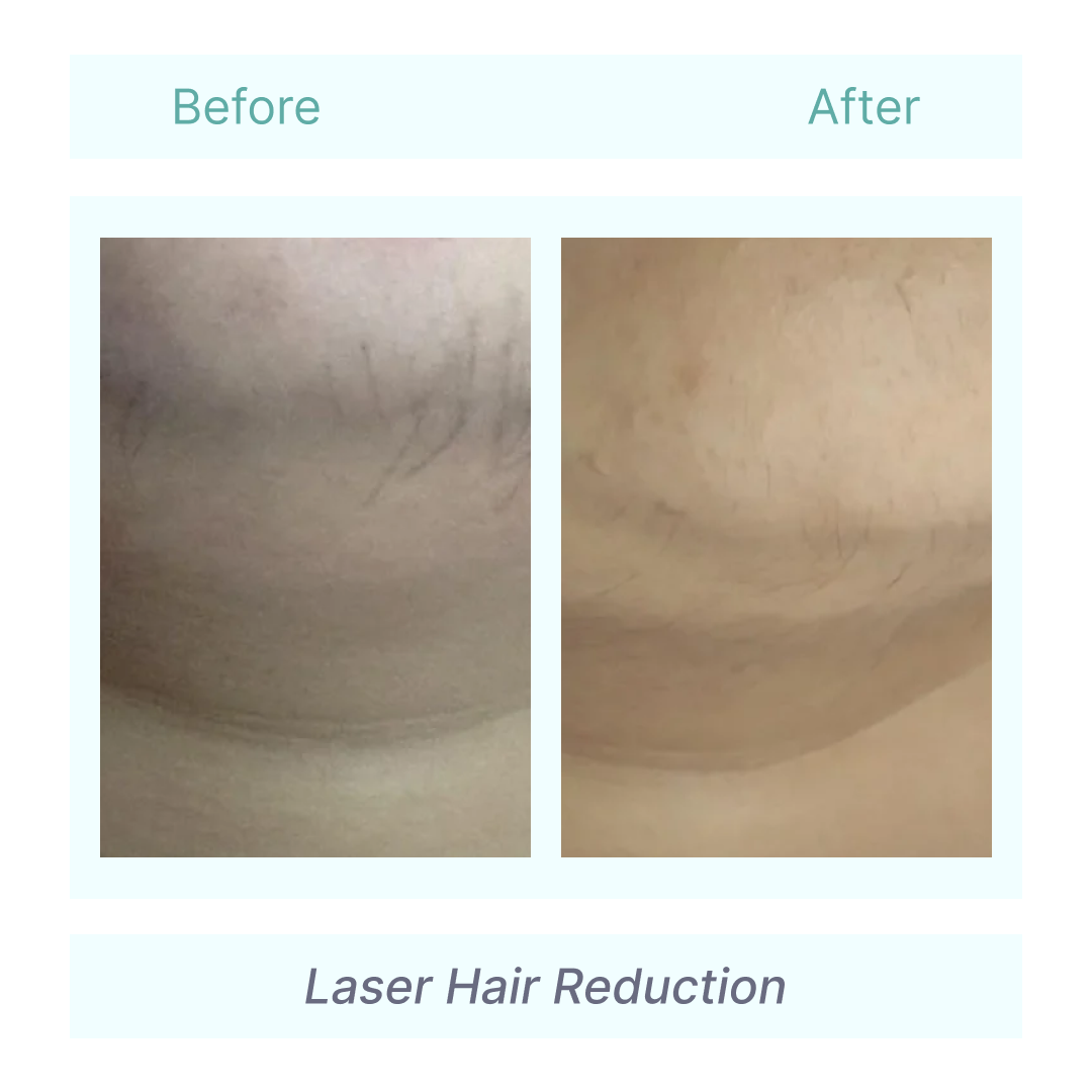Laser hair removal before and after at Tender Skin International