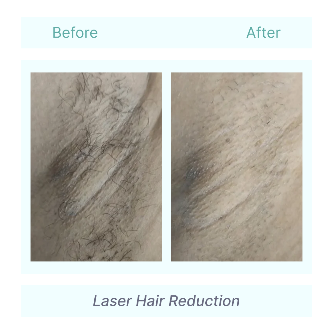 Laser hair removal before and after at Tender Skin International